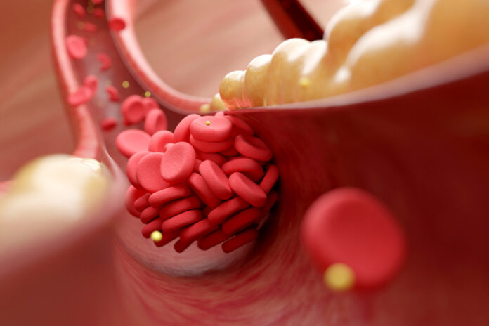 2182127660 High cholesterol and blood clot