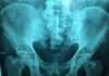 AI Tool Better than Current Screening for Hip Fracture Risk