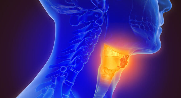 3d illustration of throat cancer